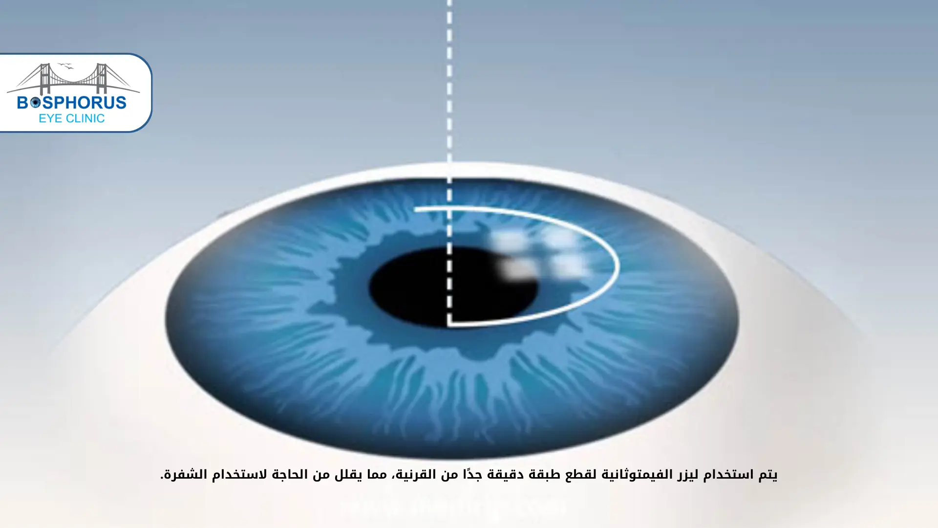 الفيمتو ليزك