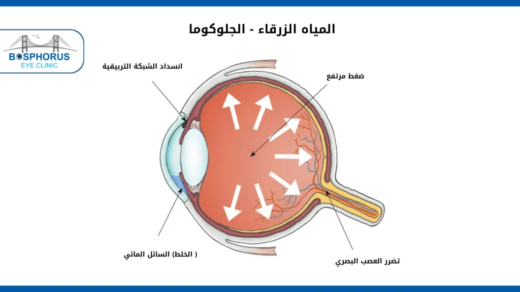 أسباب المياه الزرقاء في العين أسباب المياه الزرقاء
