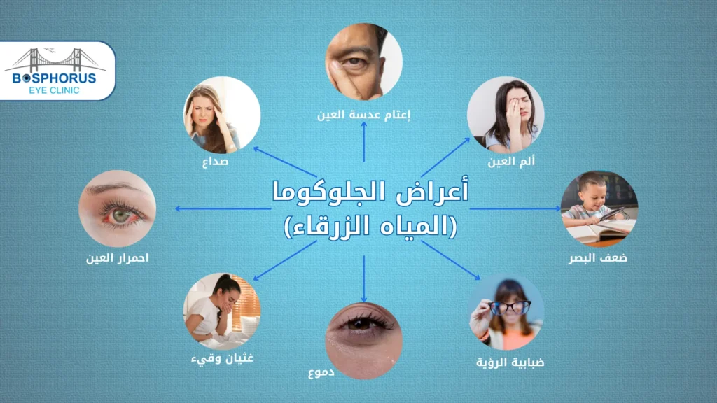 أعراض المياه الزرقاء في العين أعراض المياه الزرقاء