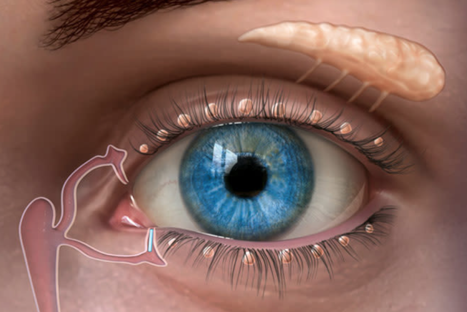 علاج جفاف العين المزمن في تركيا بتقنية LipiFlow