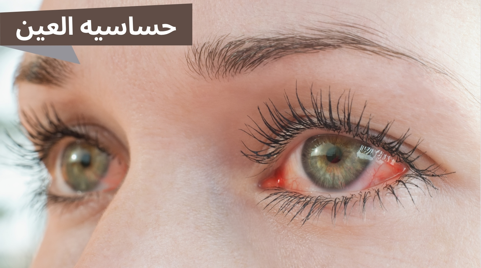 حساسية العين المزمنة