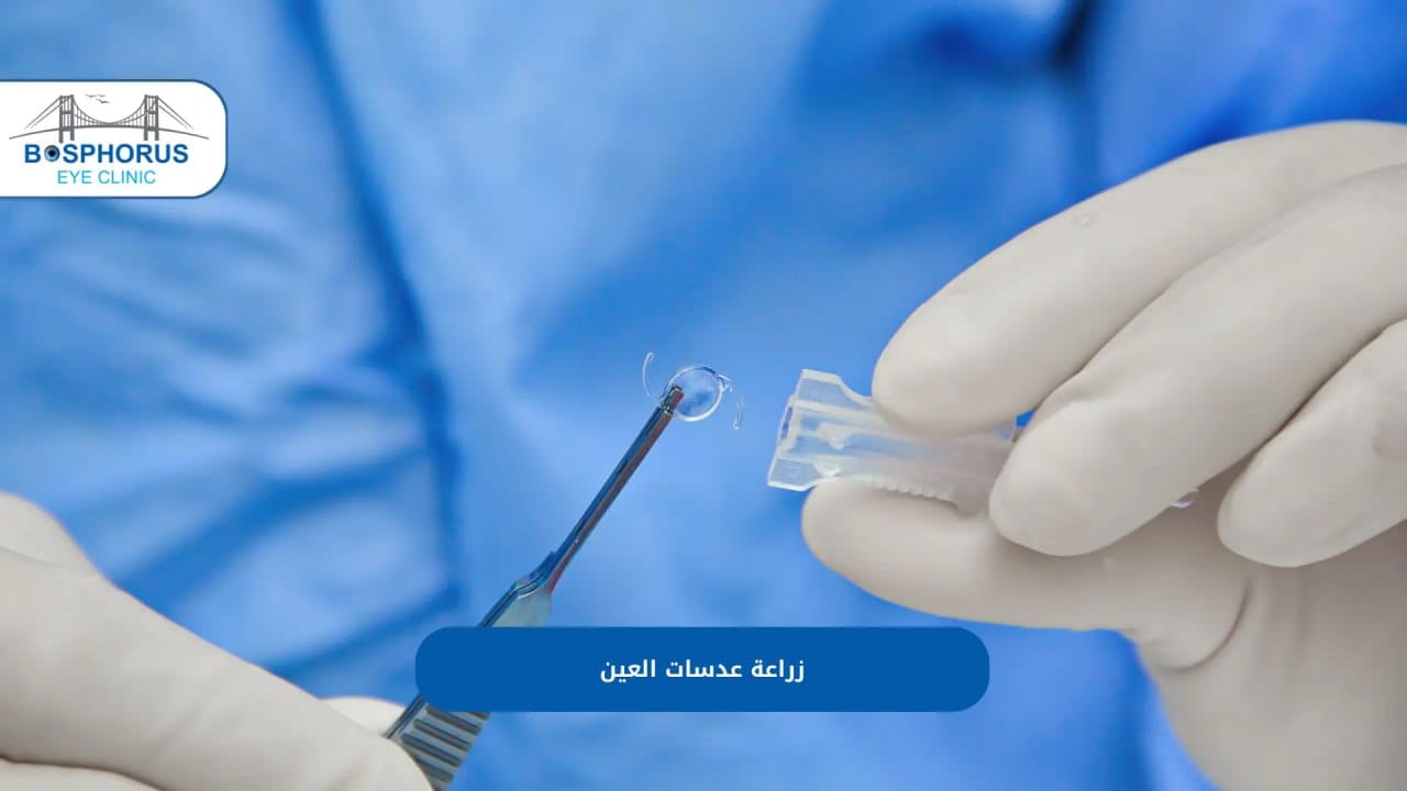 زراعة العدسات داخل العين في تركيا