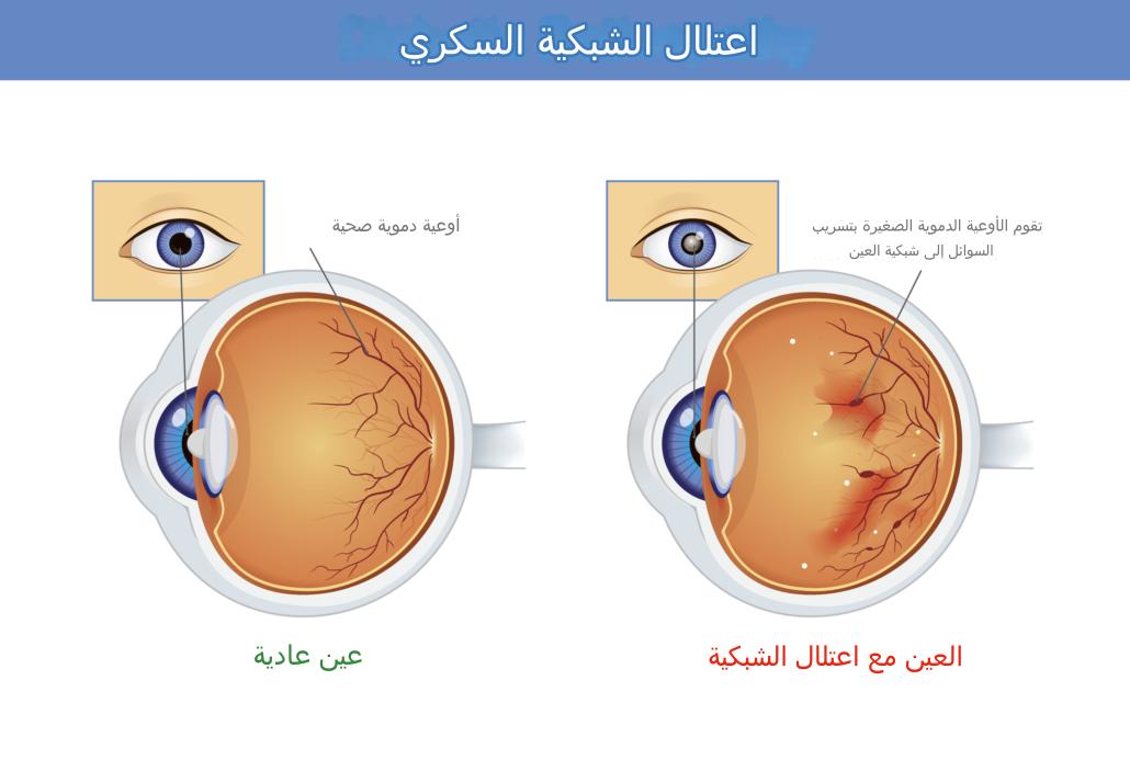 اعتلال الشبكية السكري في تركيا