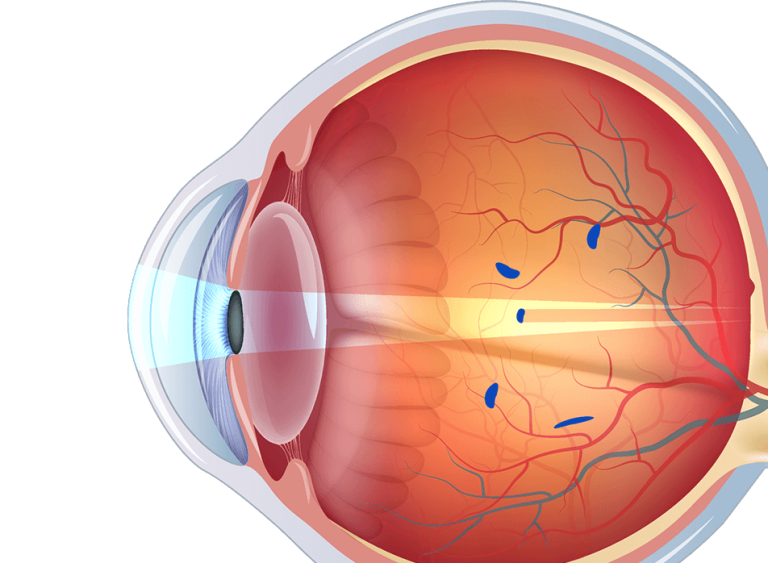 علاج أمراض الشبكية في إسطنبول