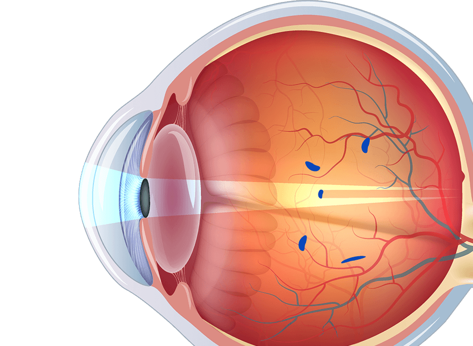 علاج أمراض الشبكية في إسطنبول