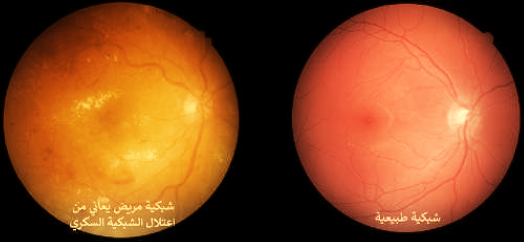 علاج اعتلال الشبكية السكري في إسطنبول