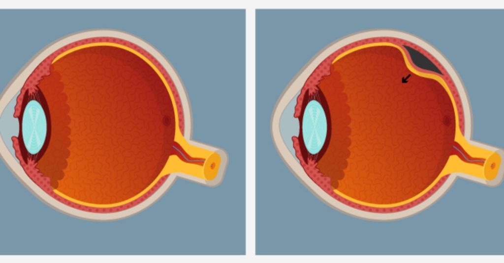 علاج انفصال الشبكية في تركيا