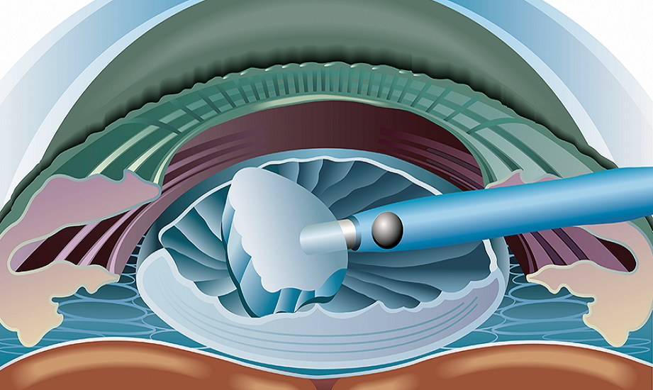 علاج المياه البيضاء في تركيا