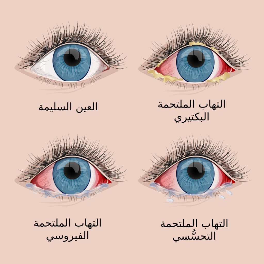 التهاب العين في تركيا