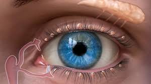 جفاف العين في تركيا