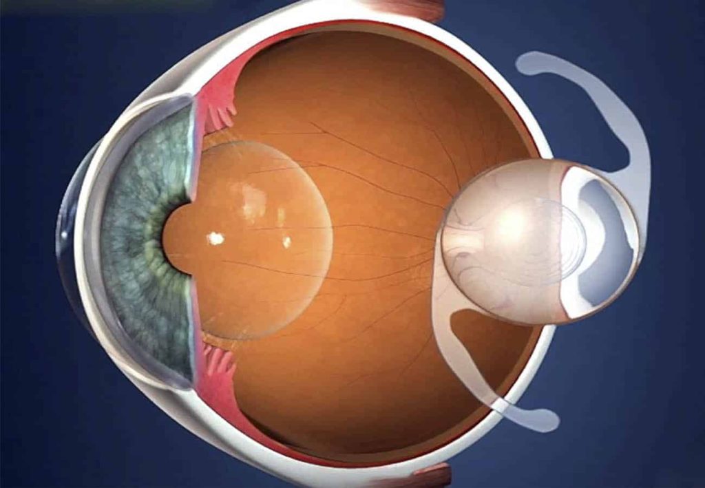 زراعة العدسات في تركيا