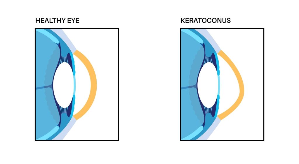 علاج القرنية المخروطية في تركيا