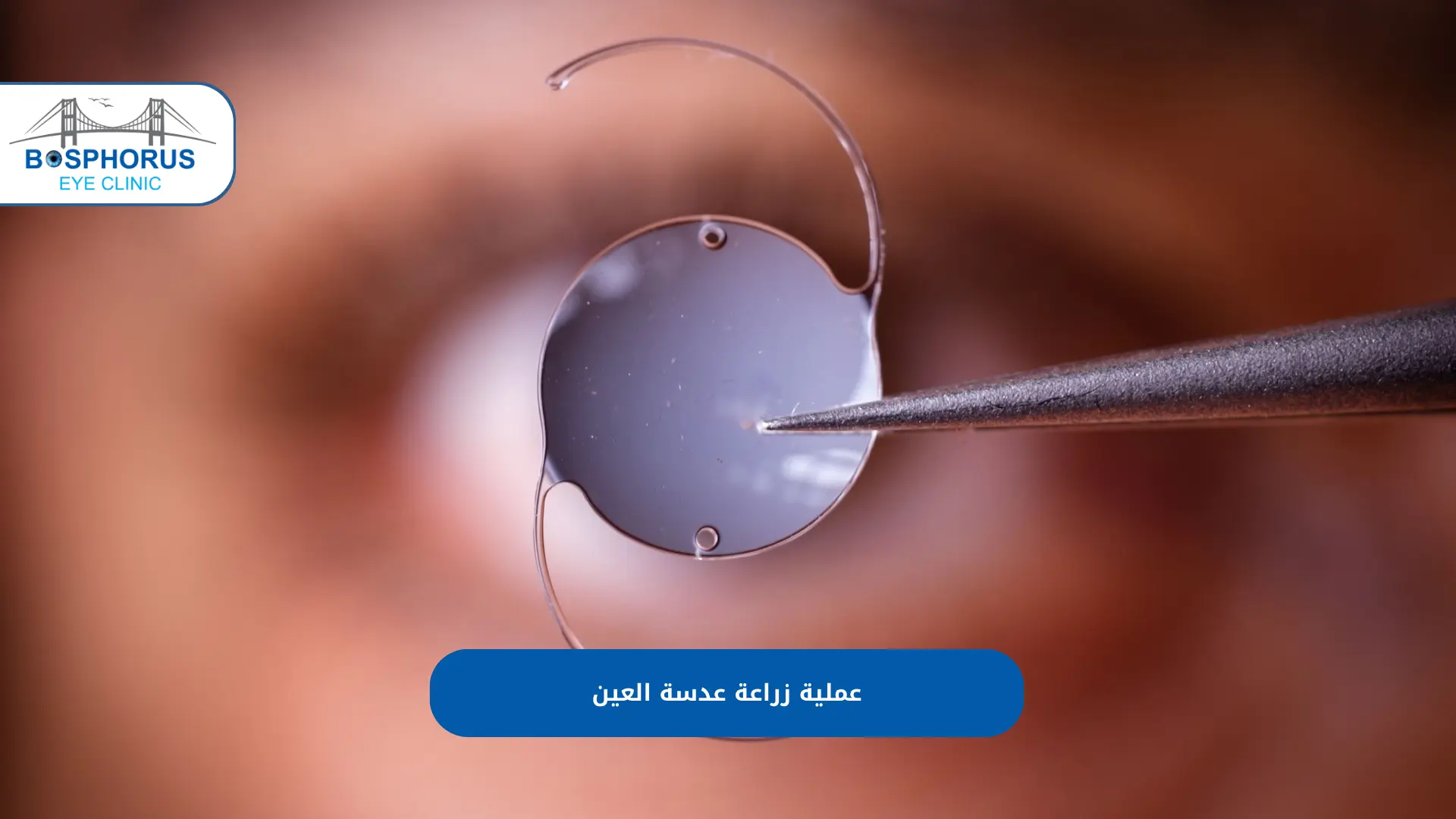 زراعة عدسات ICL في تركيا