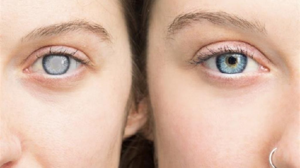 سعر عملية المياه البيضاء في تركيا