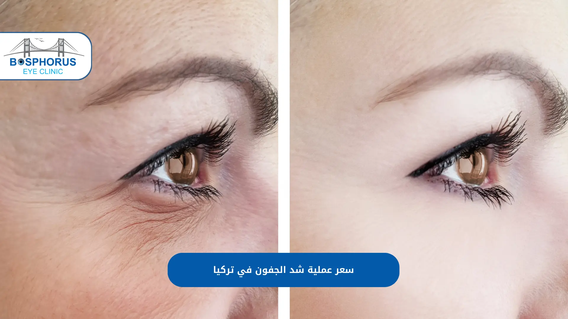 عملية شد الجفون في تركيا