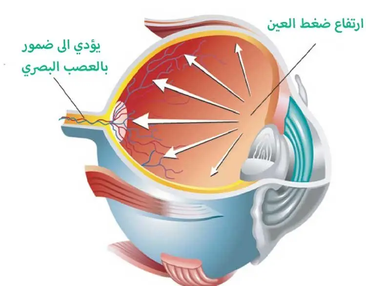 علاج المياه الزرقاء في تركيا