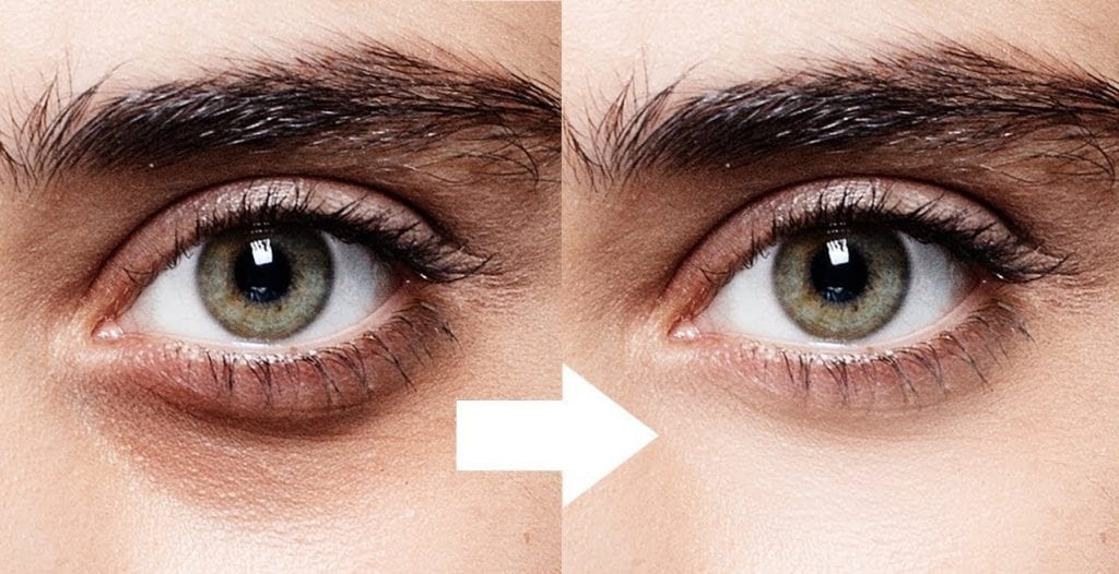 علاج الهالات السوداء وتجاويف تحت العين في تركيا