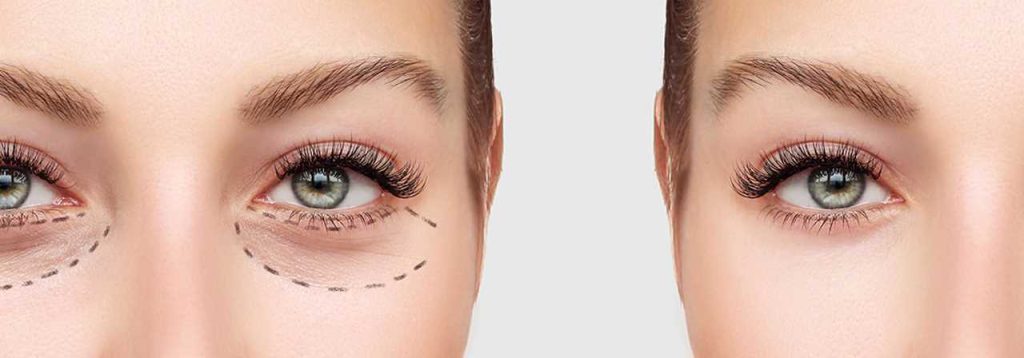 عملية شد الجفون في تركيا