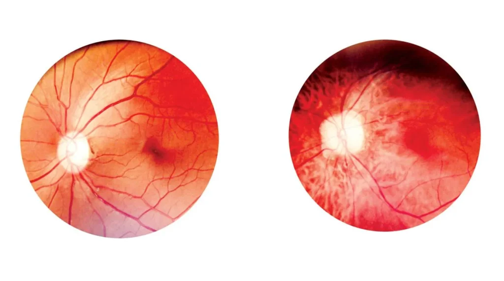 اعتلال الشبكية السكري في تركيا