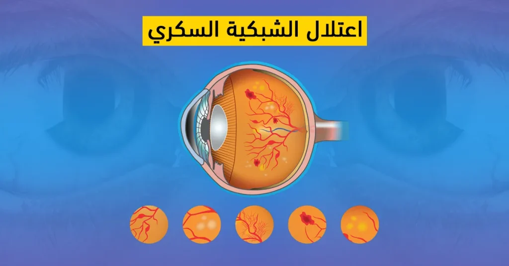 علاج اعتلال الشبكية السكري في تركيا