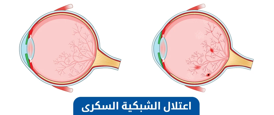 علاج اعتلال الشبكية السكري في تركيا
