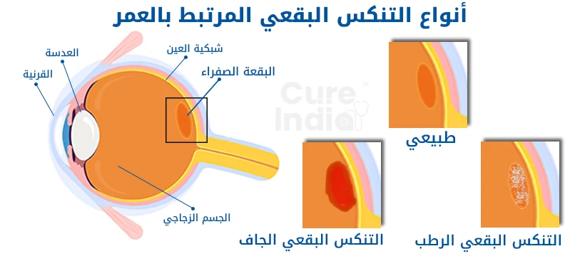 علاج الانحلال البقعي المرتبط بالسن في تركيا