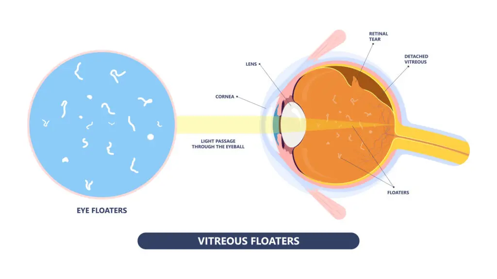 علاج العوائم الزجاجية في تركيا