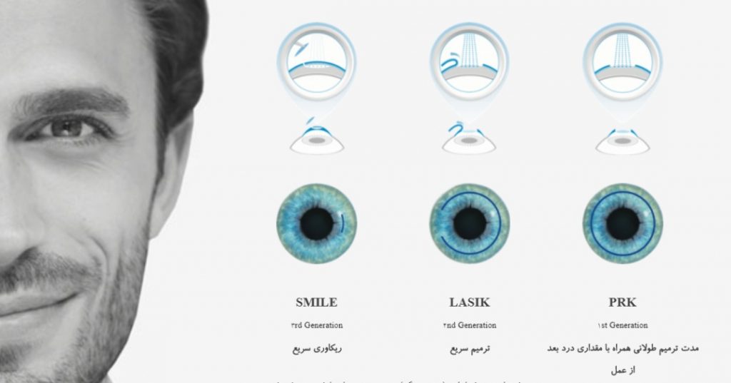 عملية SMILE لتصحيح النظر في تركيا
