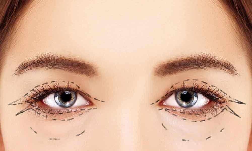 عملية شد الجفون في تركيا