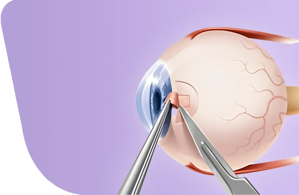 الجلوكوما (المياه الزرقاء) وجراحة MIGS في تركيا