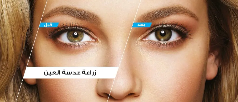 زراعة العدسة ICL للقصر الشديد في تركيا