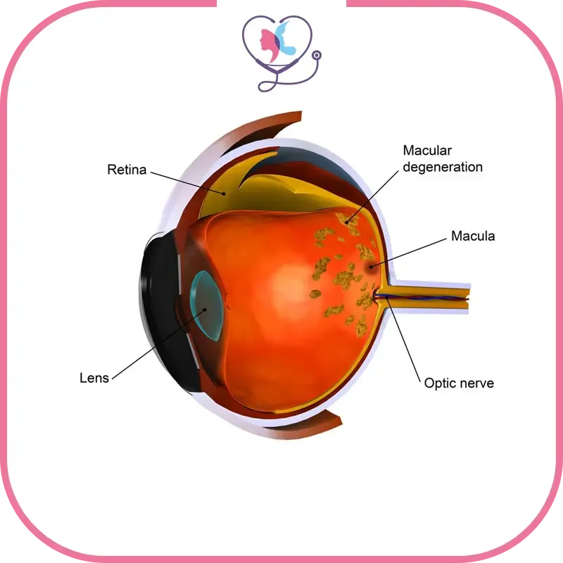 علاج التنكس البقعي الرطب بحقن Vabysmo في تركيا