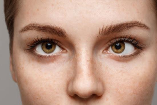 علاج الحول عند الكبار في تركيا