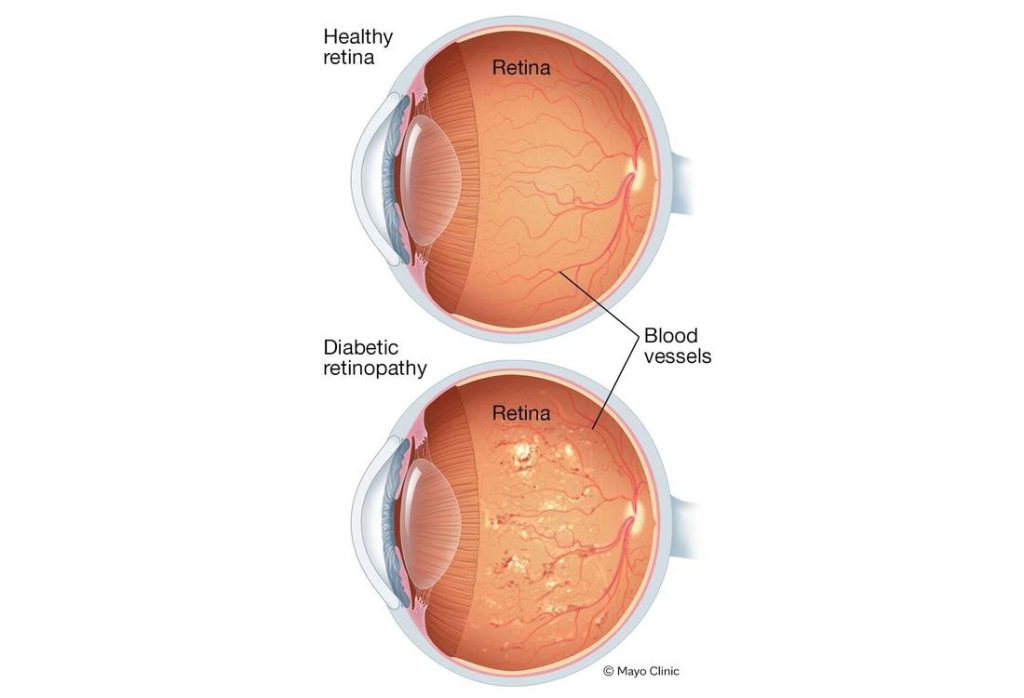 علاج الوذمة البقعية السكرية في تركيا 