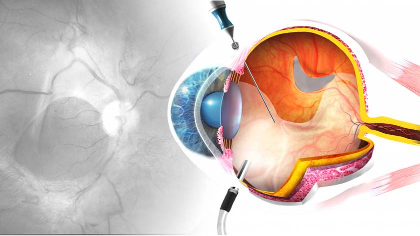 علاج انفصال الشبكية في تركيا