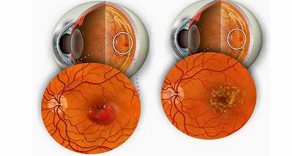 علاج ثقب شبكية العين بالليزر في تركيا