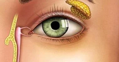 انسداد القناة الدمعية