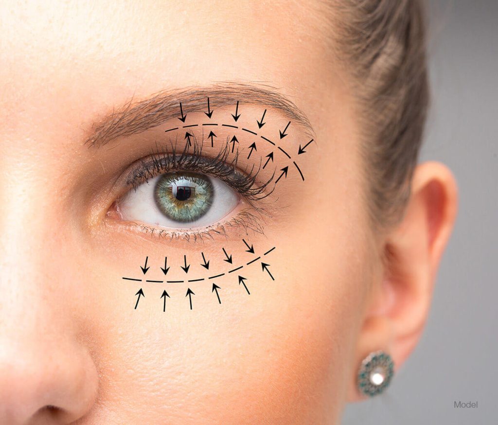 جراحة الجفن Blepharoplasty في تركيا 