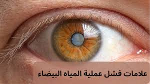 علامات فشل عملية المياه البيضاء