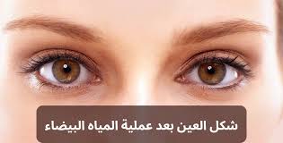 علامات فشل عملية المياه البيضاء