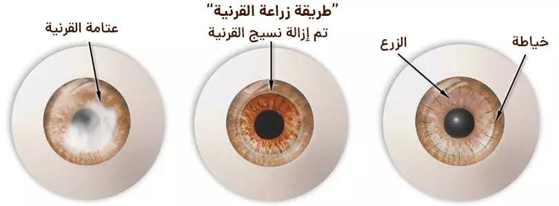 زراعة القرنية في تركيا