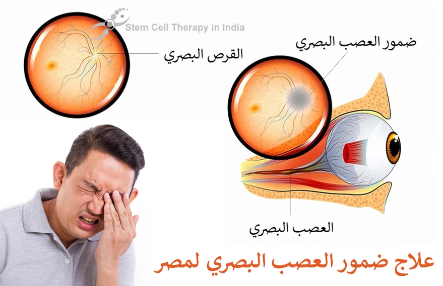 عصب العين وعلاجه