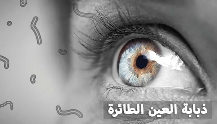 علاج الذبابة الطائرة في العين