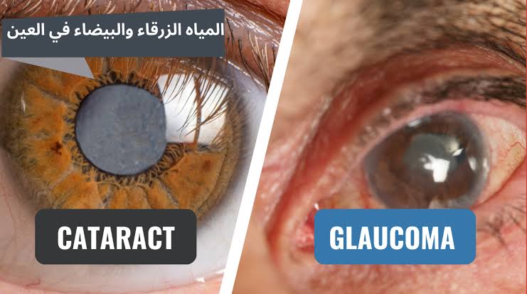 علاج المياه الزرقاء في العين 