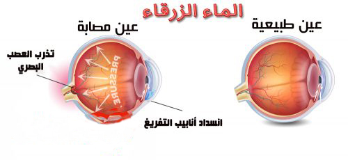 https://drabdurrahman.com/service/glaucoma/