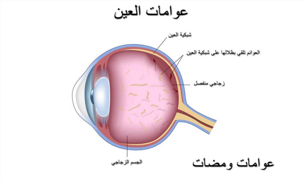 علاج الذبابة الطائرة في العين