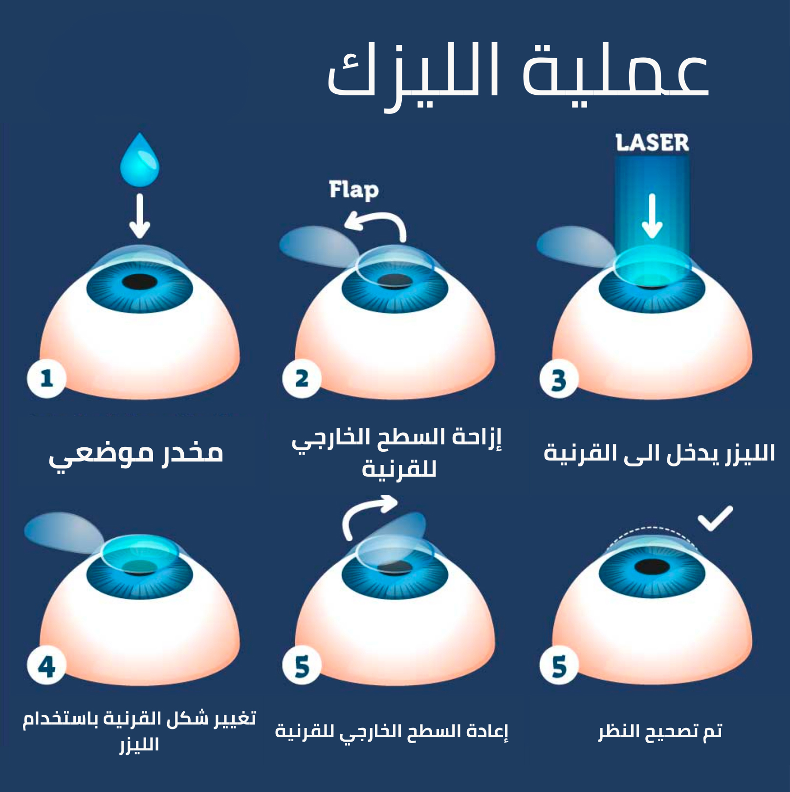مدة عملية الليزك للعيون
