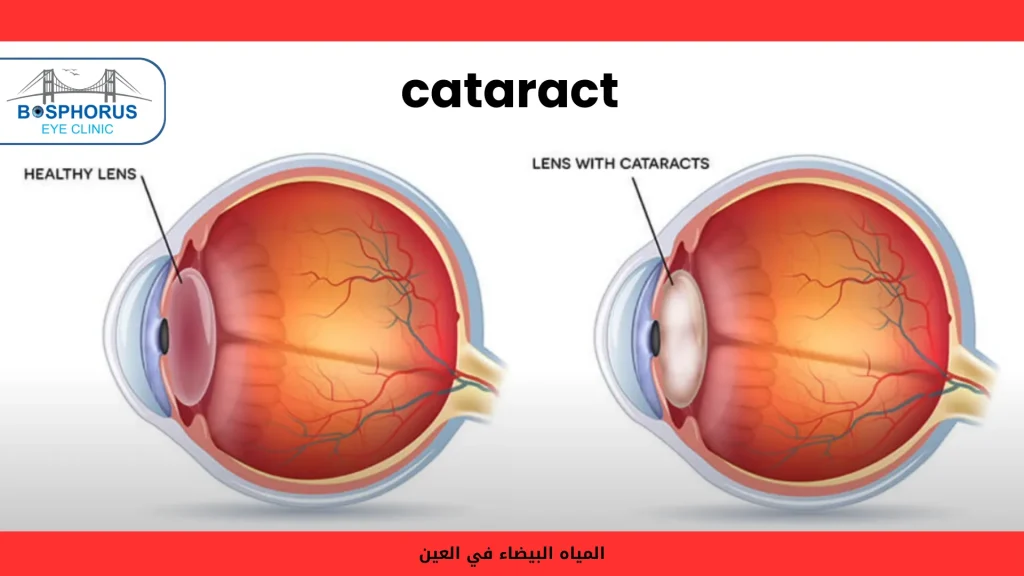 اعراض الماء الابيض في العي