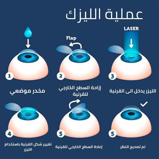 الفرق بين الليزك والفيمتو ليزك وسمايل