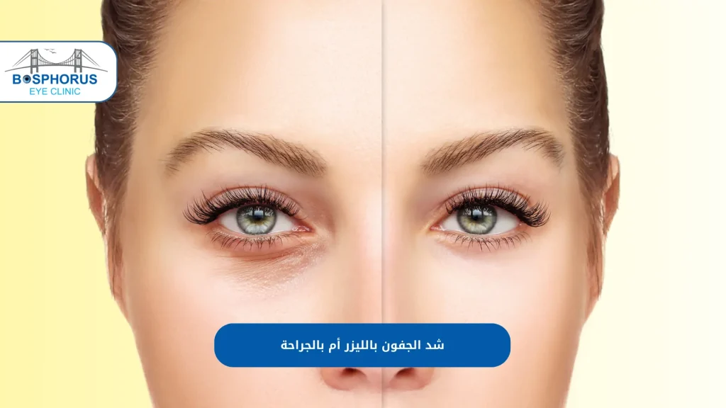 عملية شد الجفون بالليزر